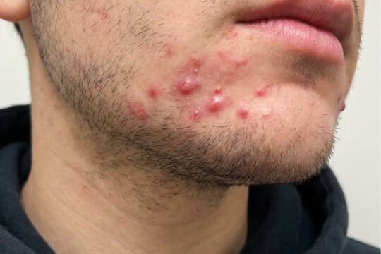I WAS TREATING HIS ACNE ALL WRONG